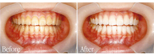 白い歯になるホワイトニング