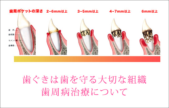 歯ぐきは歯を守る大切な組織。歯周病治療について